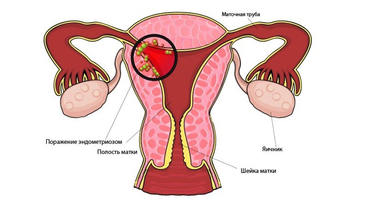 Эндометриоз – лечение: консервативное или хирургическое? — Женская Академия  Здоровья