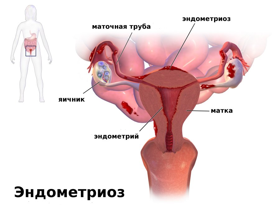 Как развивается эндометриоз — Женская Академия Здоровья