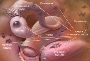 эндометриоз мочевого пузыря