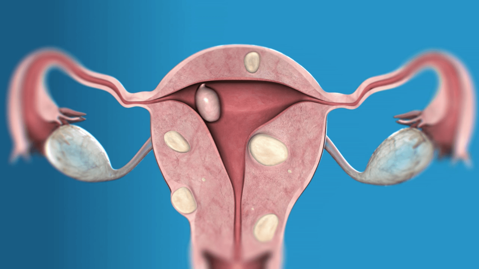 Endometriosis mioma