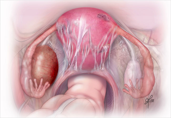 Эндометриоидная киста яичника - лечение