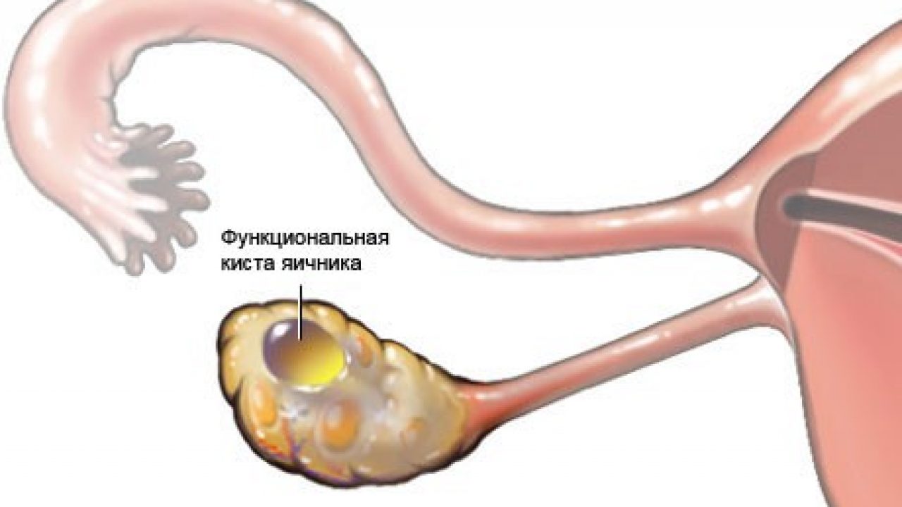 Функциональная киста яичника — Женская Академия Здоровья