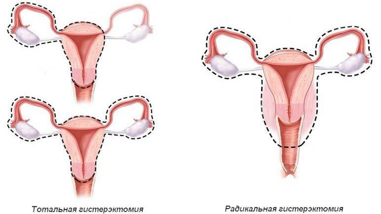 Гистерэктомия — удаление матки — Женская Академия Здоровья