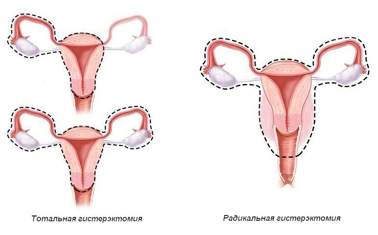 Экстирпация матки. Экстирпация матки (тотальная гистерэктомия). Тотальная и радикальная гистерэктомия. Гистерэктомия с придатками. Гистерэктомия Вертгейма.