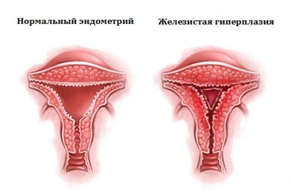 Все, что нужно знать про эндометрий — Женская Академия Здоровья