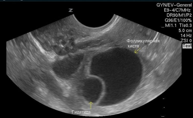 Вышла киста яичника фото